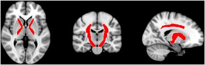 Somatosensory evoked potentials and their relation to microstructural damage in patients with multiple sclerosis—A whole brain DTI study